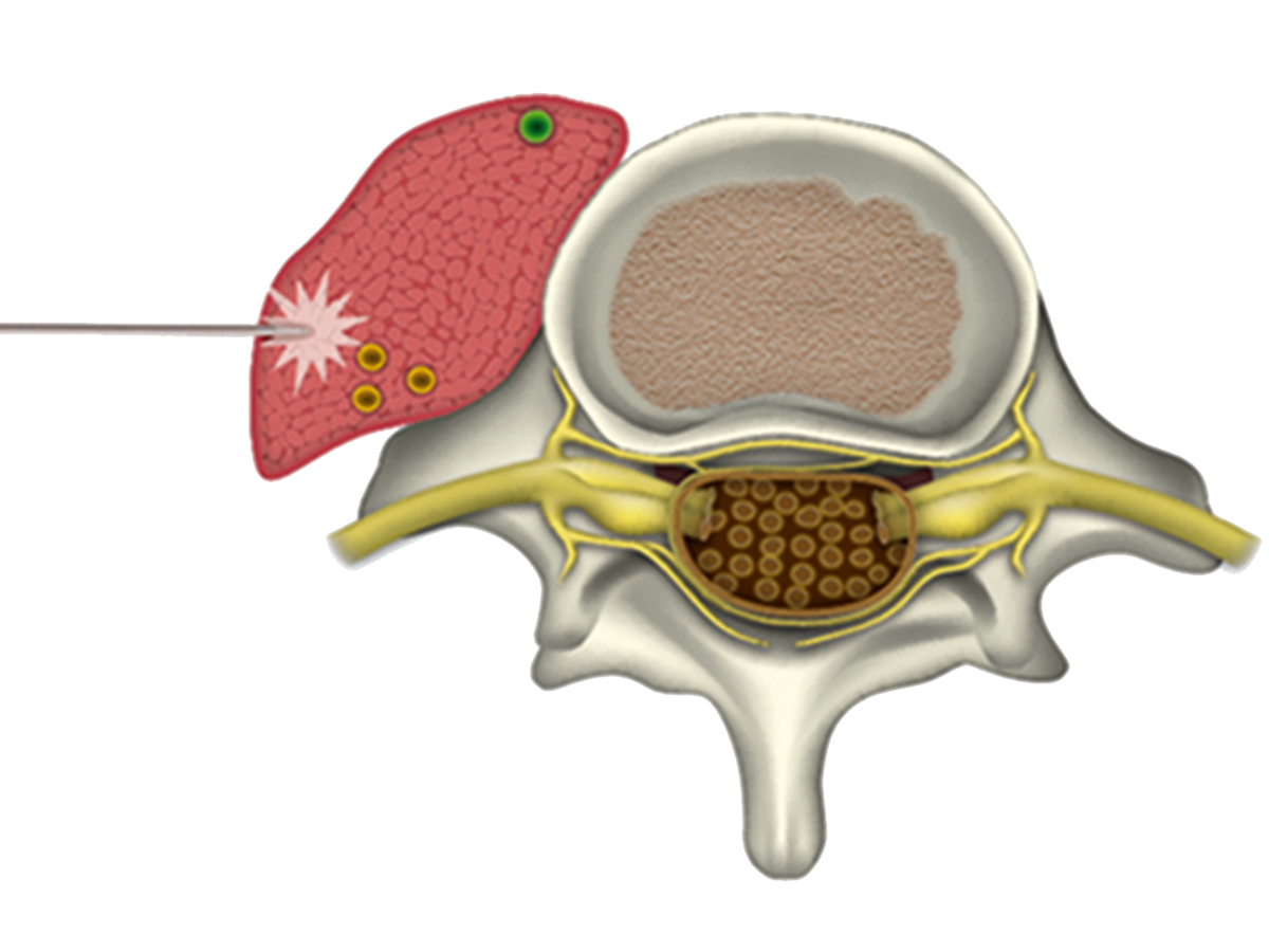 Illustration: Wirbel mit Muskel Illustration: Wirbel mit Muskel